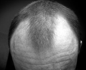 Androgene alopecia