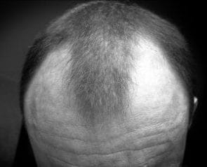 Androgene alopecia