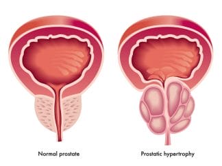  hypertrofie van de prostaatklier